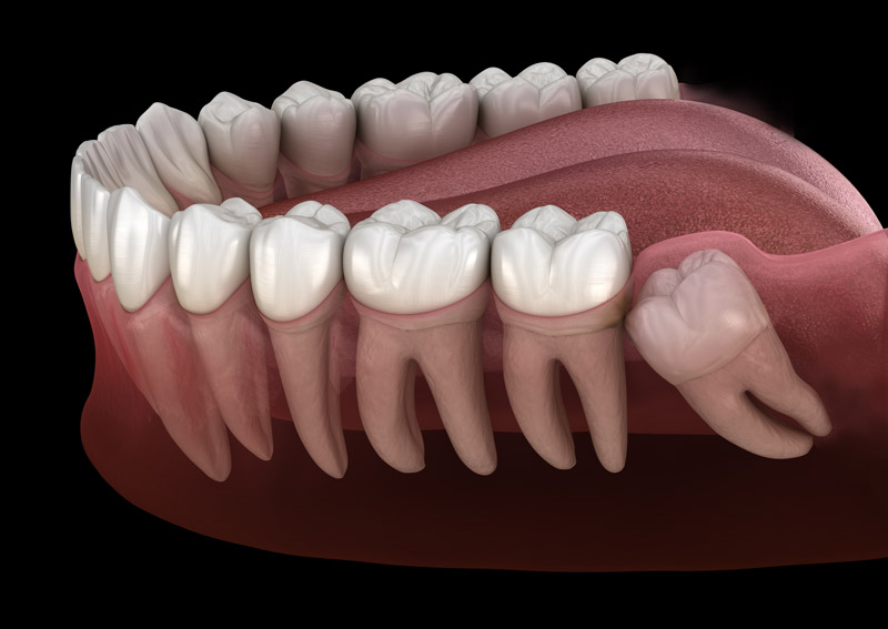 3d rendering of a lower jaw showing a wisdom tooth under the gum line