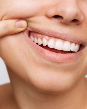 women showing gums / teeth 300 x 375